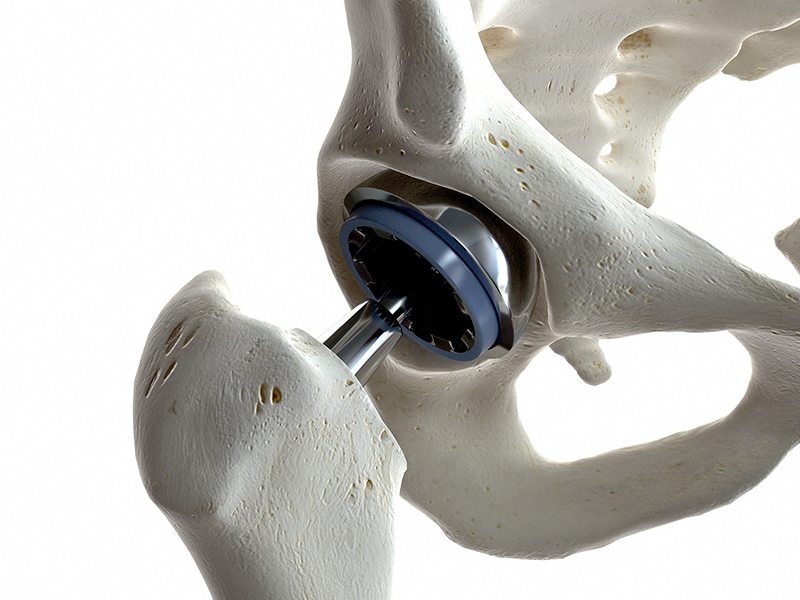 Prótesis de cadera y rodilla
