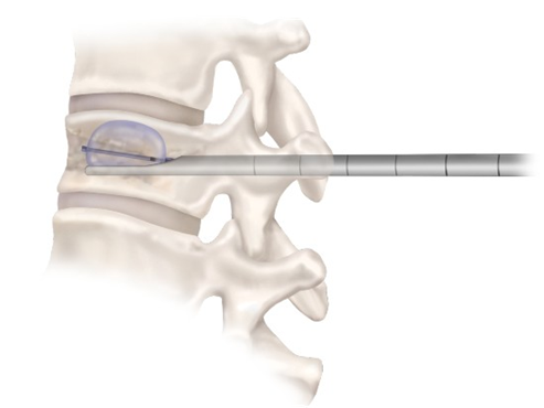 Balón de cifoplastia